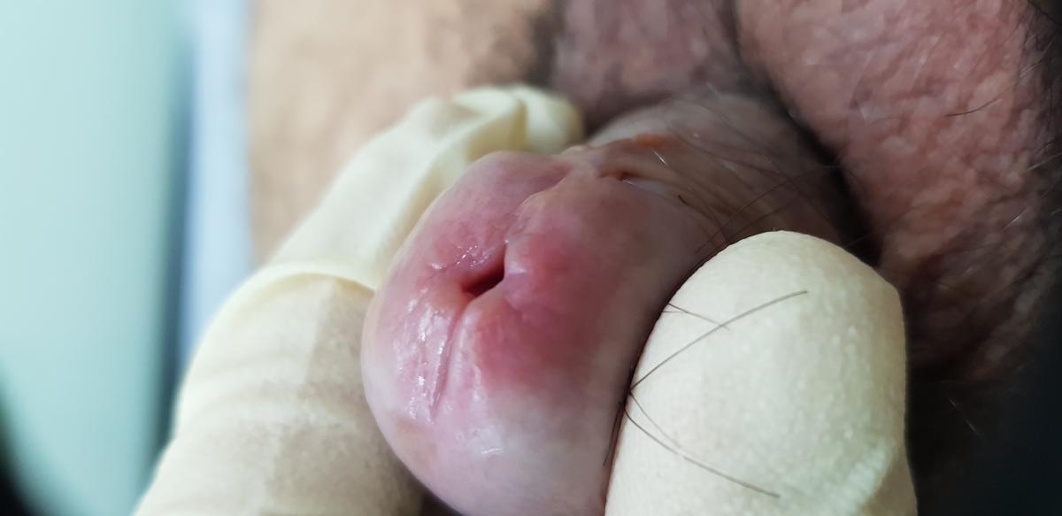 Уреаплазмоз и гарднереллез