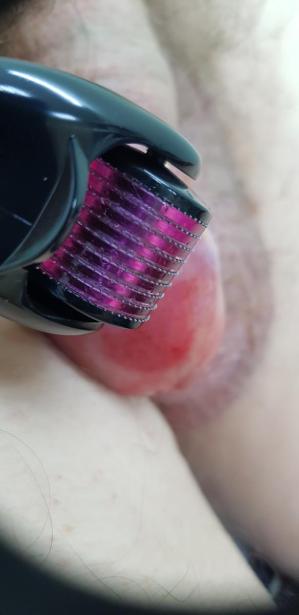 плазмолифтинг дермороллером плазмолифтинг