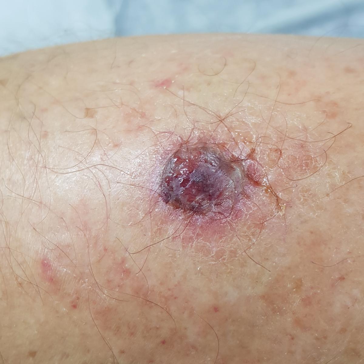 Поверхностная базилиома голени Поверхностная базилиома при сифилисе