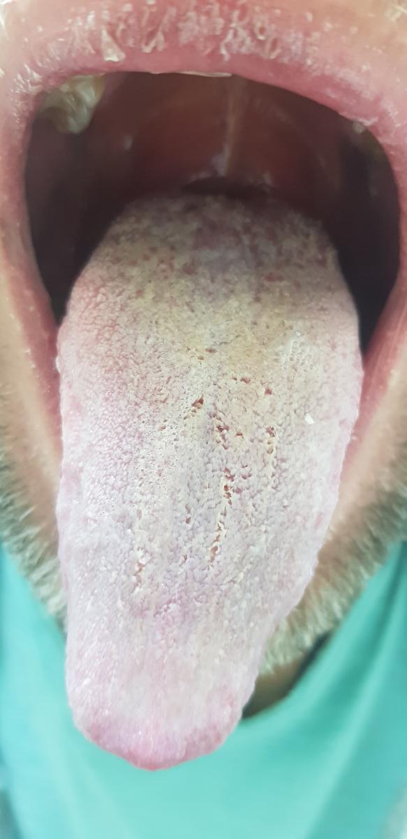 Белый язык до лечения