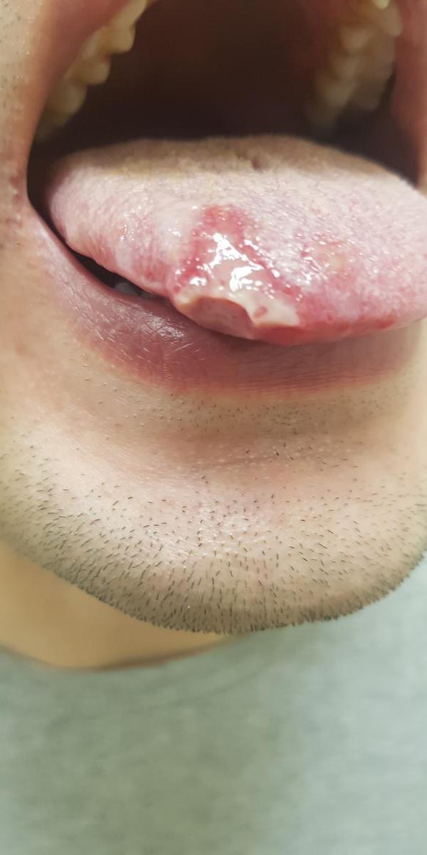  уреаплазма живет во рту 