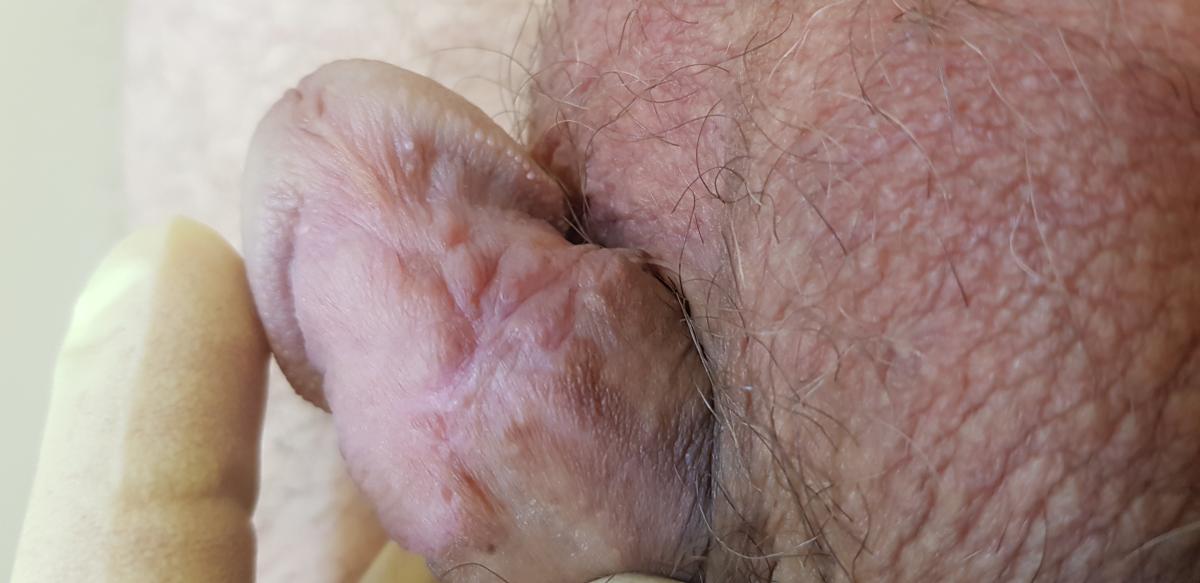 боли в рубце