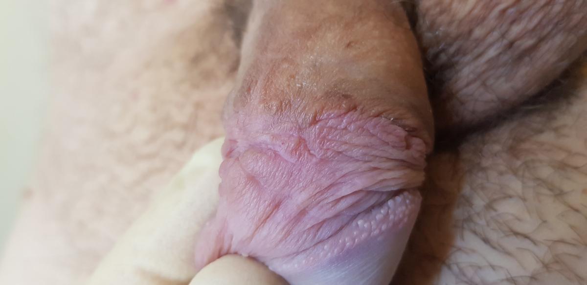 боли в рубце