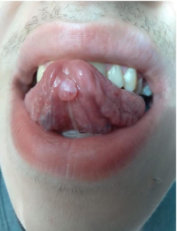  уреаплазма через рот