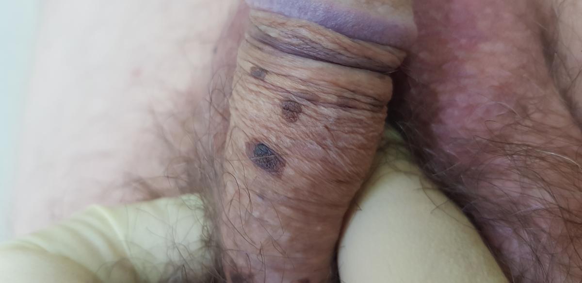 Темные папулы на плоти и головке ВПЧ