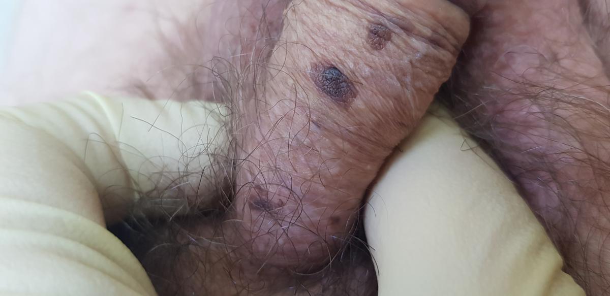 Темные папулы на плоти ВПЧ