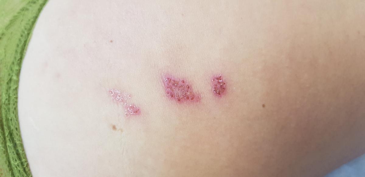 герпес на ягодицах