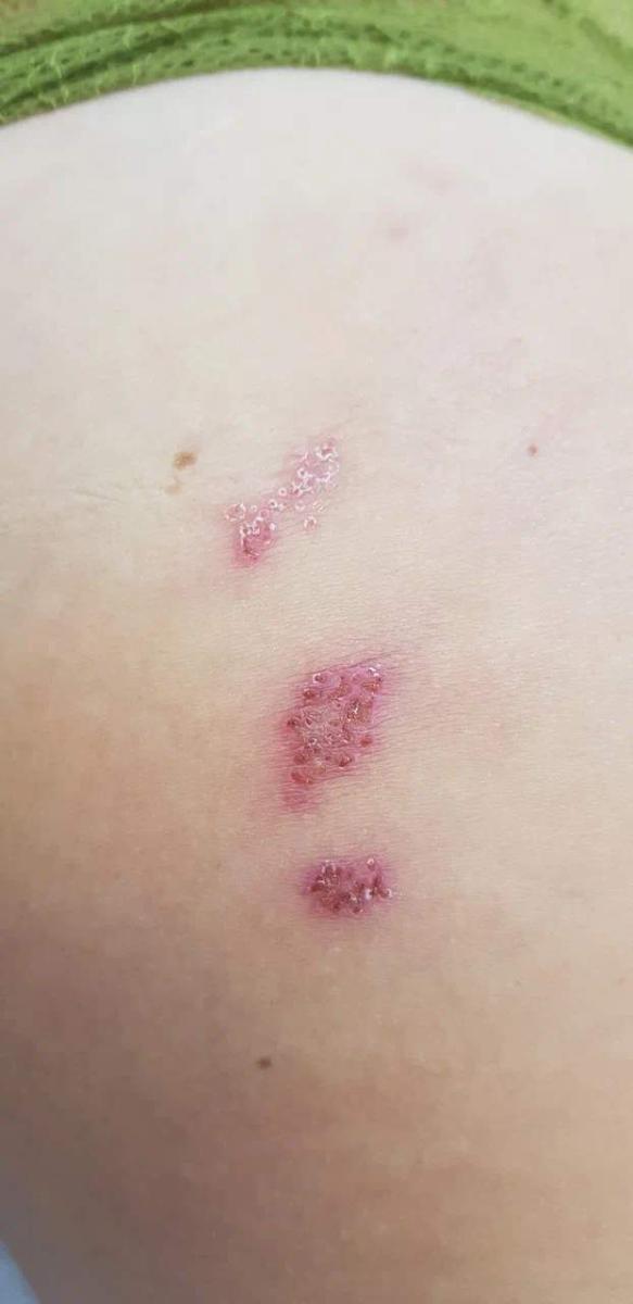 герпес- вирусная ИППП