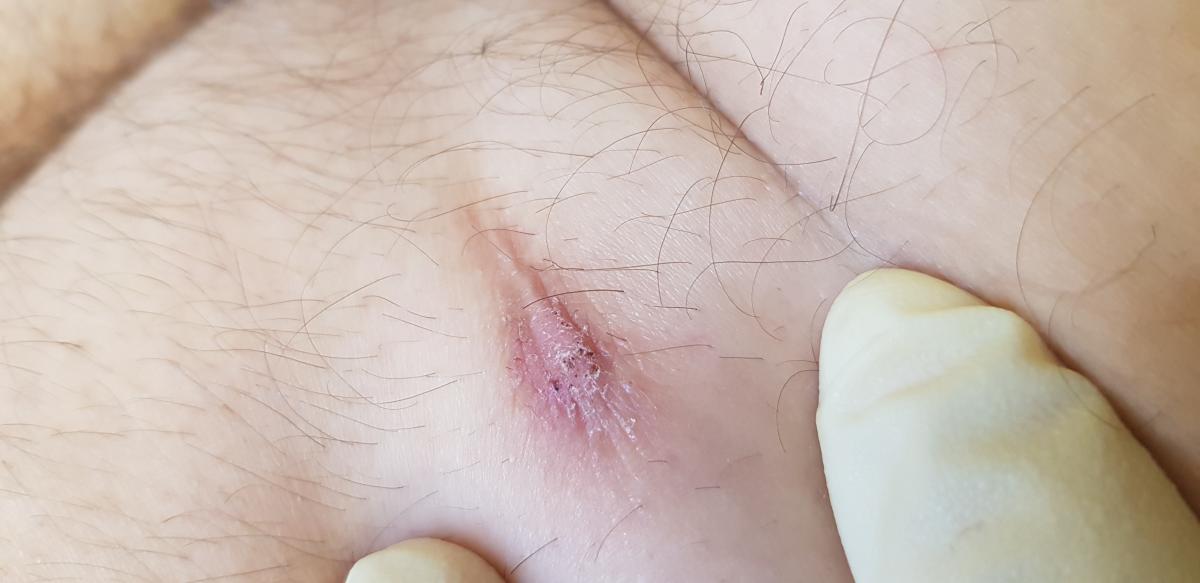 рубец на ягодице через 3 дня через три дня