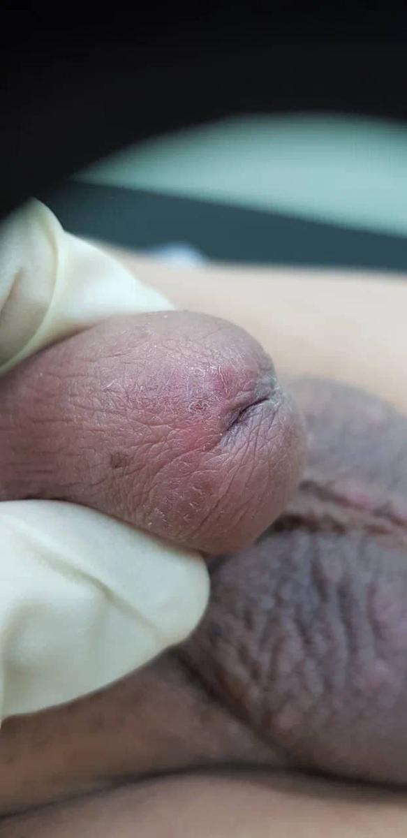 чесотка чесотка