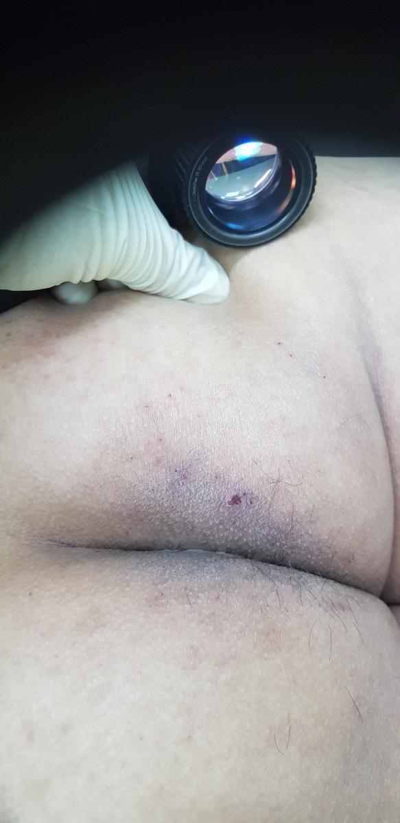 твердый прыщ на половой губе