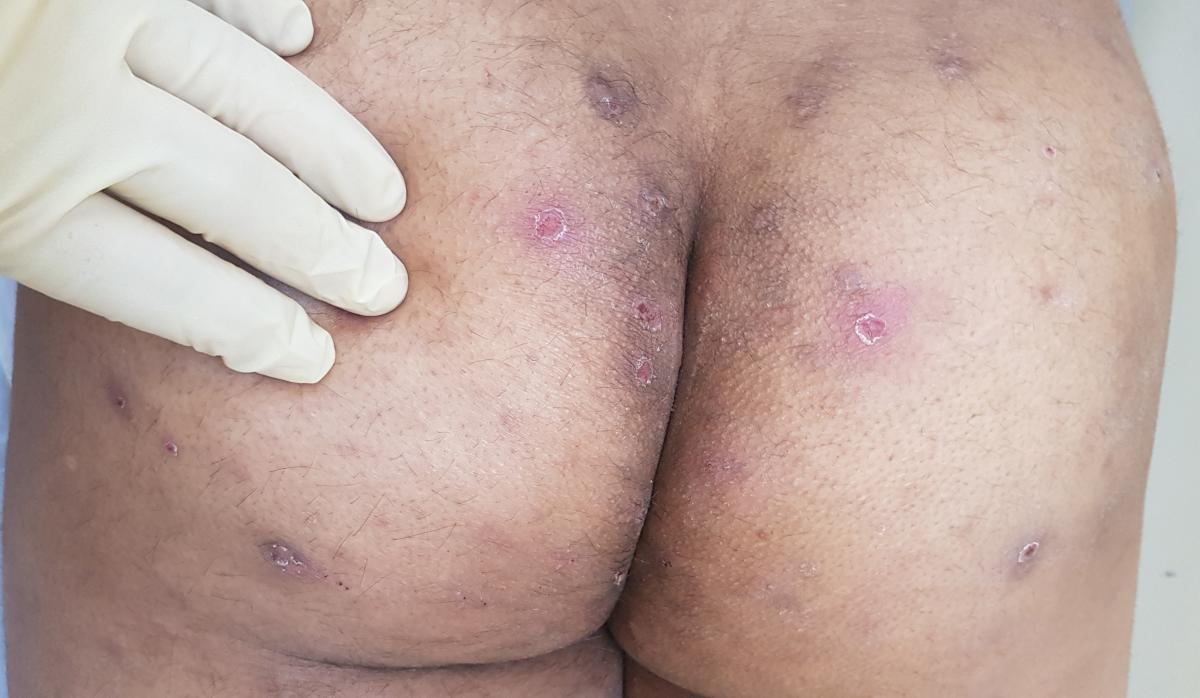 чесотка осложненная чесотка осложненная эктимами