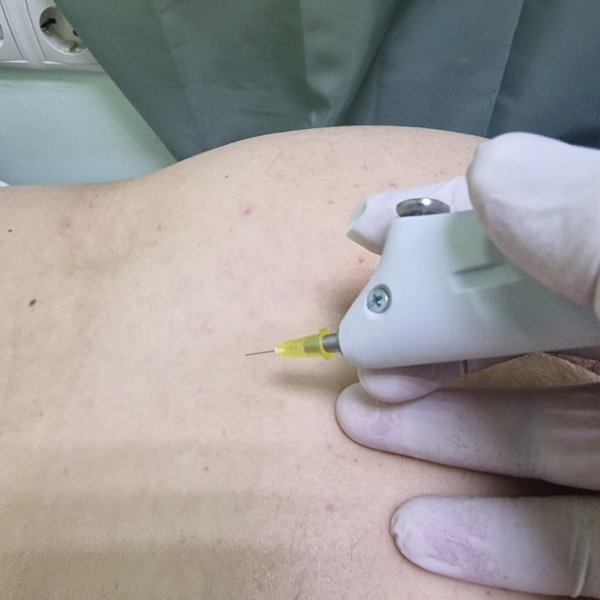 Инъекции углекислого газа Инъекции углекислого газа