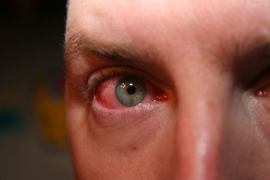 Сифилис поражает глаза
