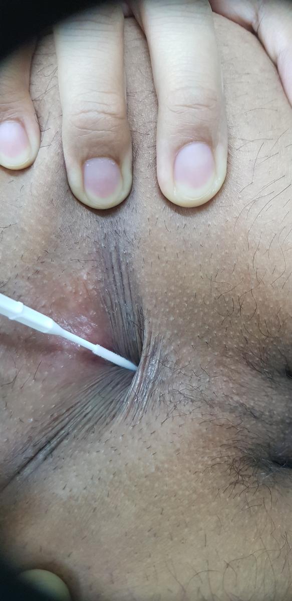 Мазок на инфекции из ануса Мазки на инфекции