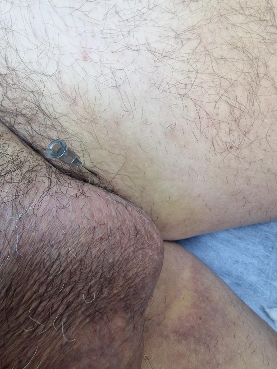 Лимфотропка