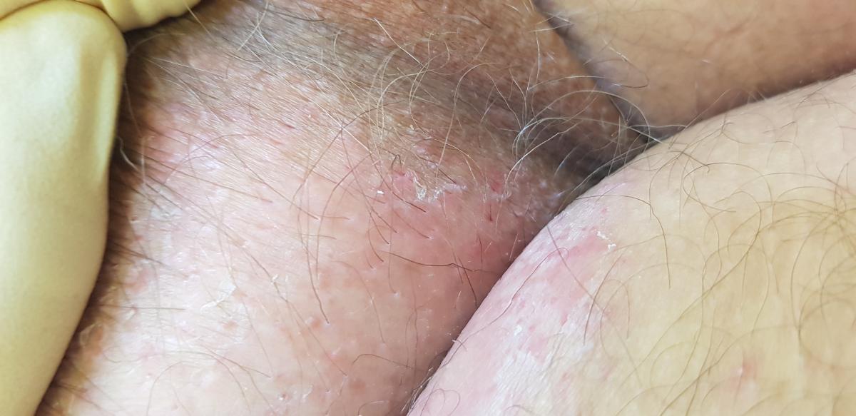 Эритразма в паху