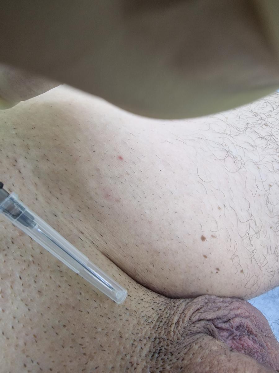 лимфотропная терапия лимфотропка