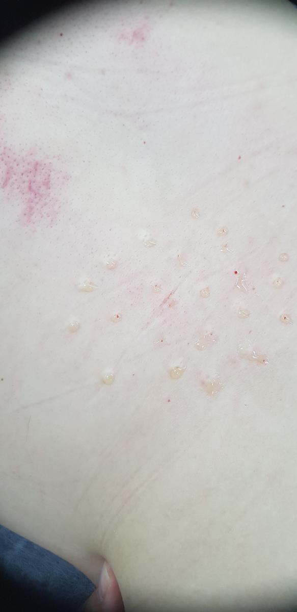 плазмолифтинг