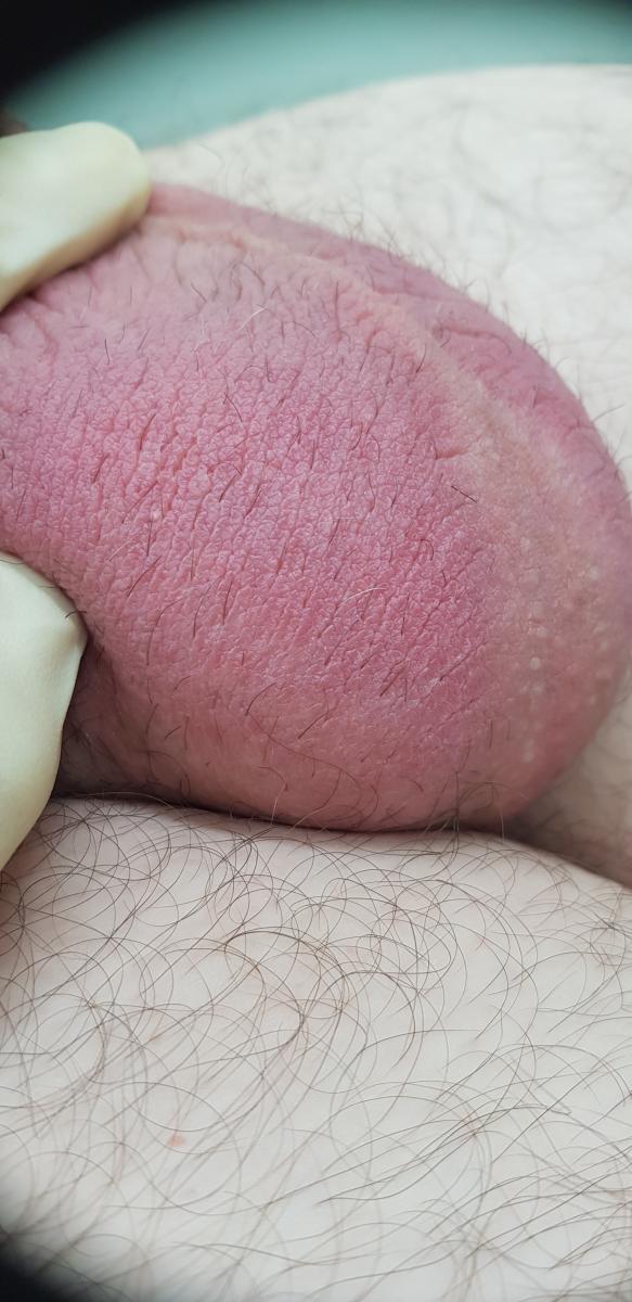 мошонка отекла