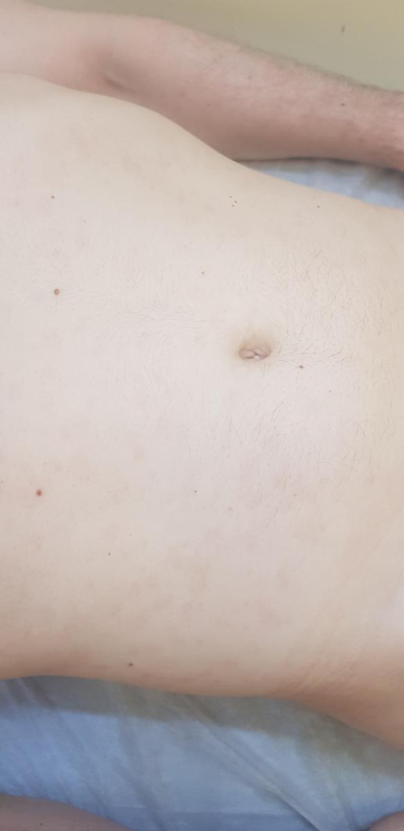 вторичный сифилис