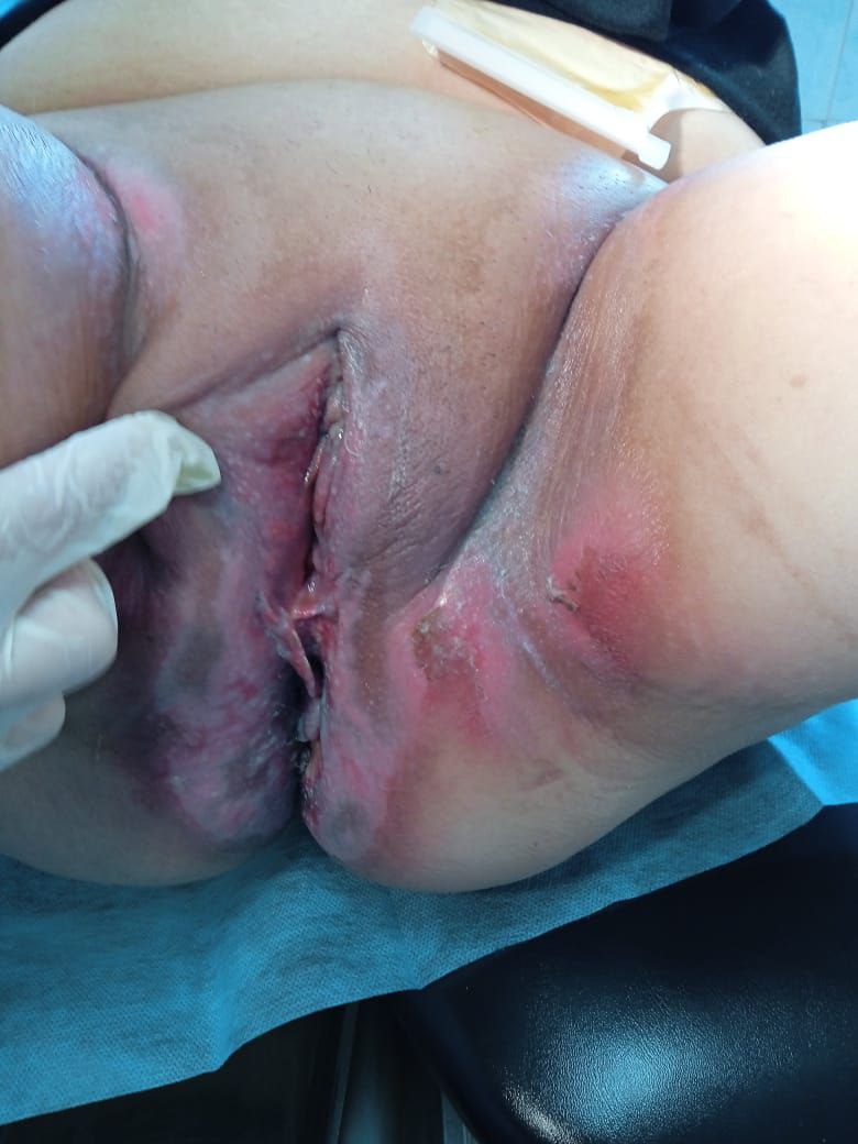 Патогенная флора Микрофлора влагалища