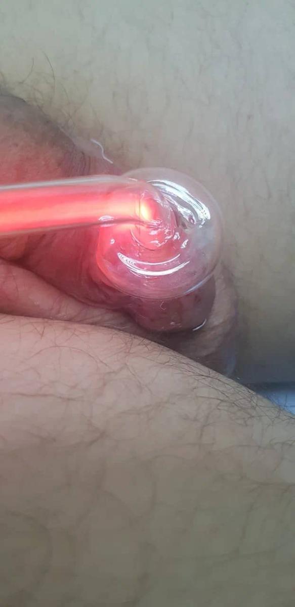 Токи дарсонваль