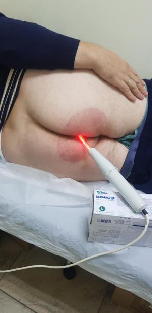 дарсонваль ануса при геморрое дарсонваль