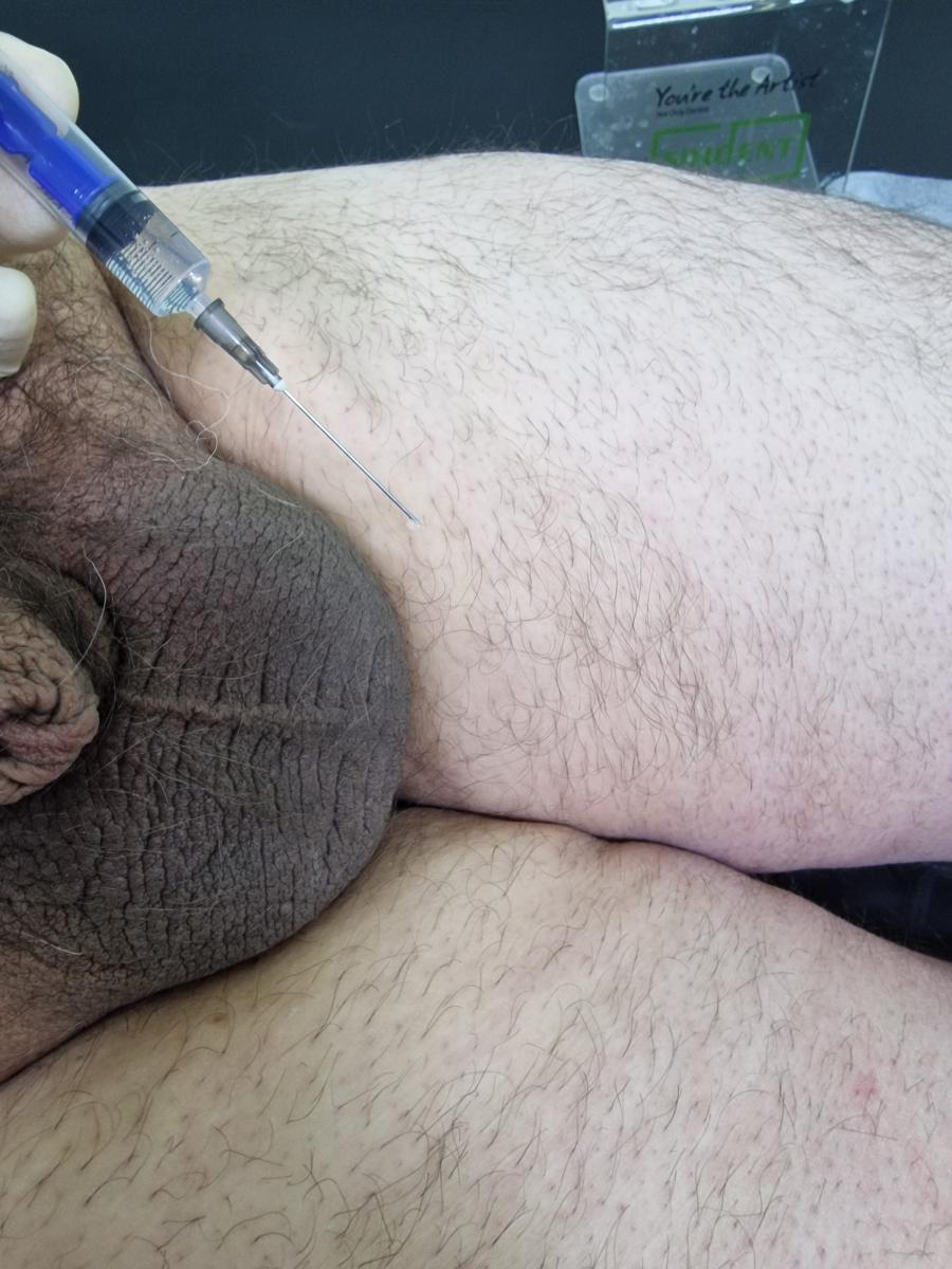 Лимфотропное введение антибиотиков лимфотропка