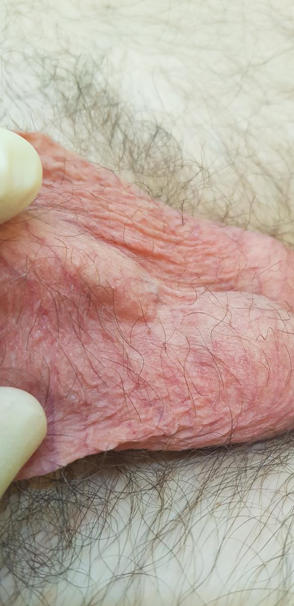 Жжение и боль в коже мошонки Жжение в коже мошонки
