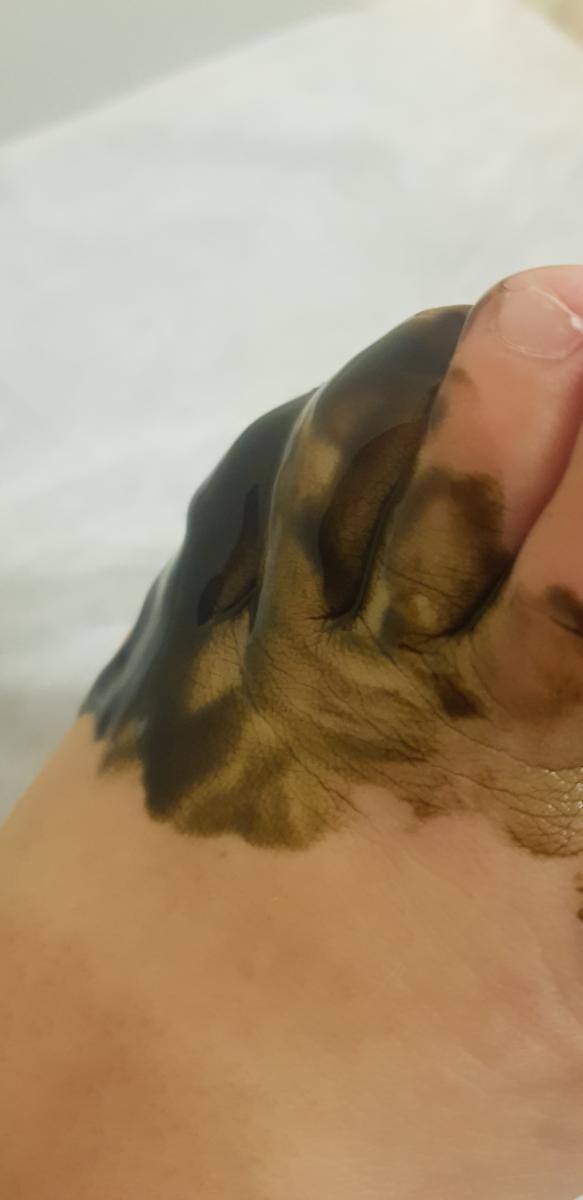нанесение фотосенсибилизатора фотодинамика