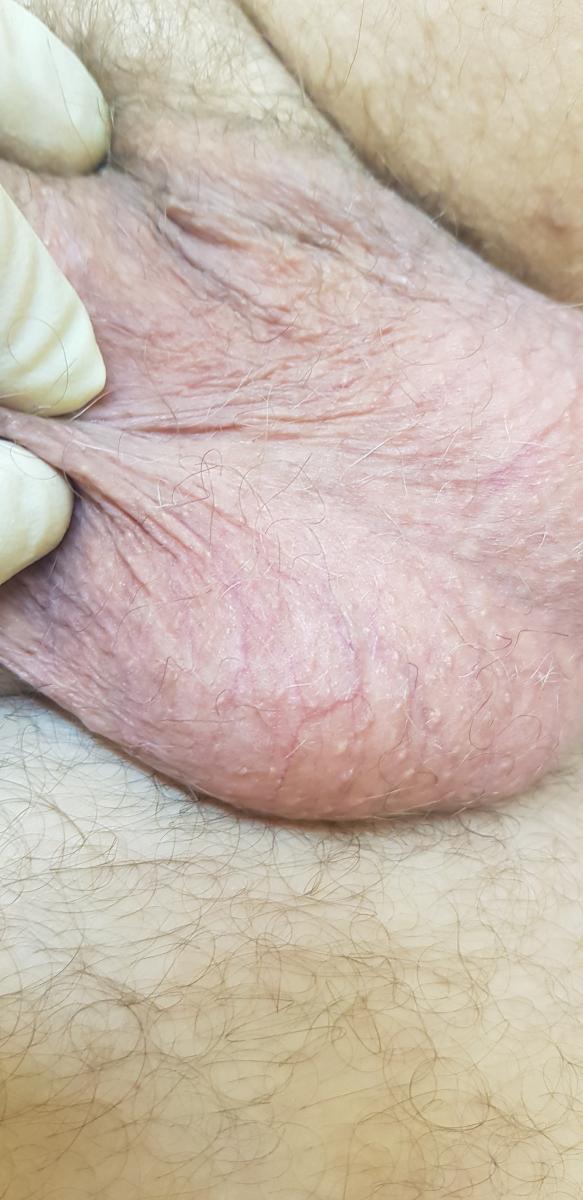 после фотодинамической терапии и плазмолифтинга плазмолифтинг и фотодинамика
