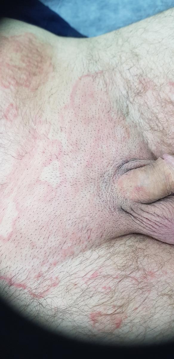 эпидермофития