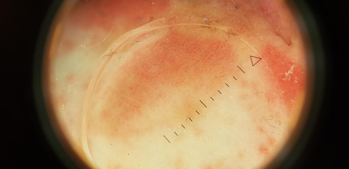 дерматоскоп