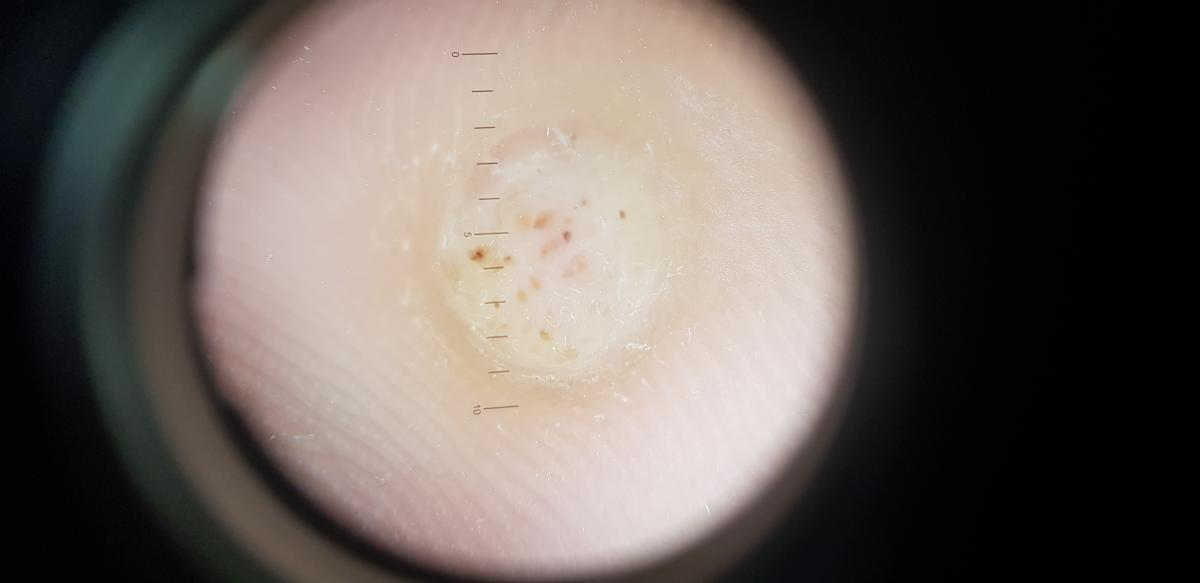 дерматоскопия