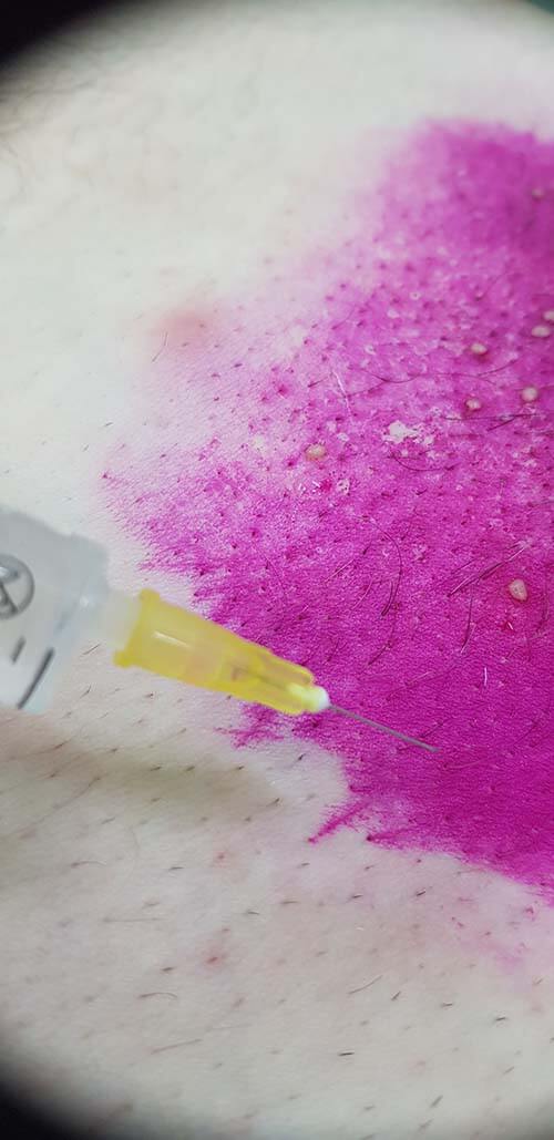 Лимфотропное введение антибиотиков