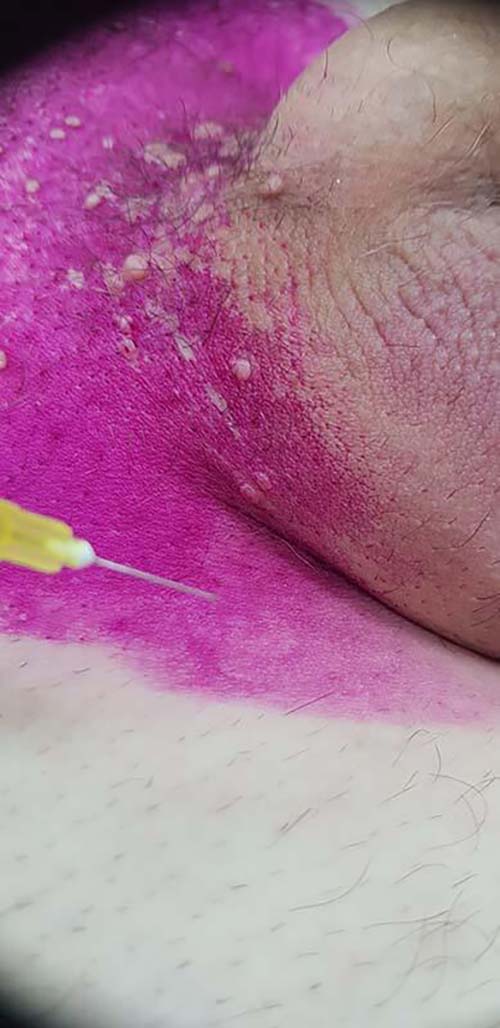 Лимфотропное введение антибиотиков