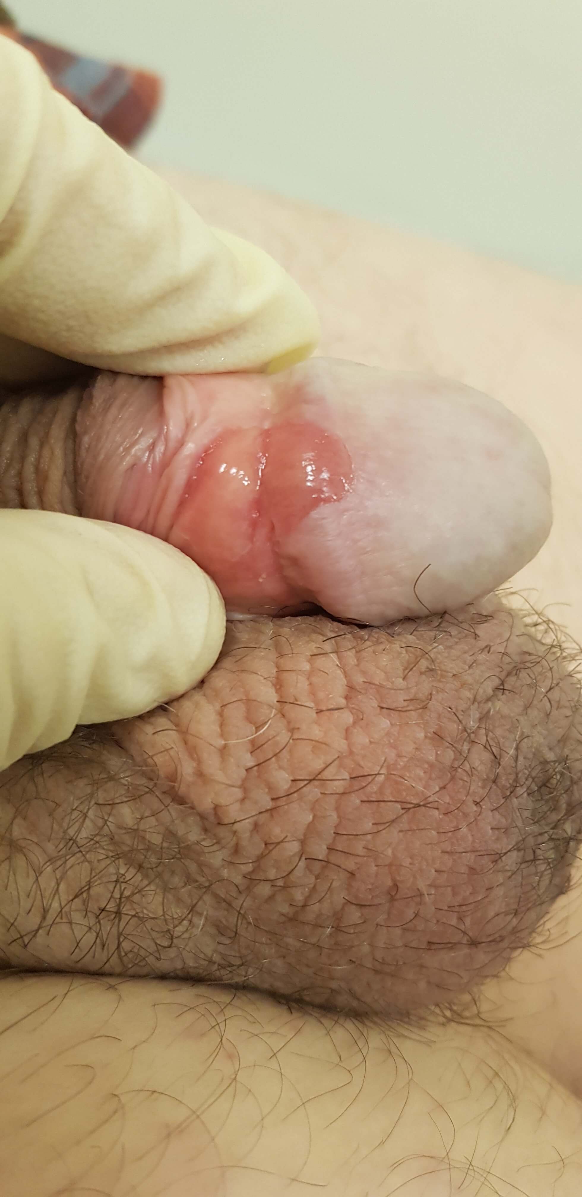 заражение при случайном сексе