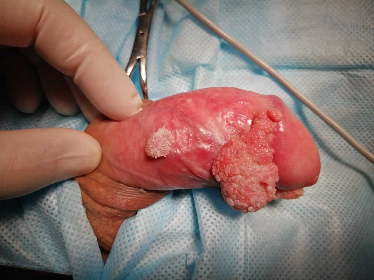 оперативное удаление кондилом до