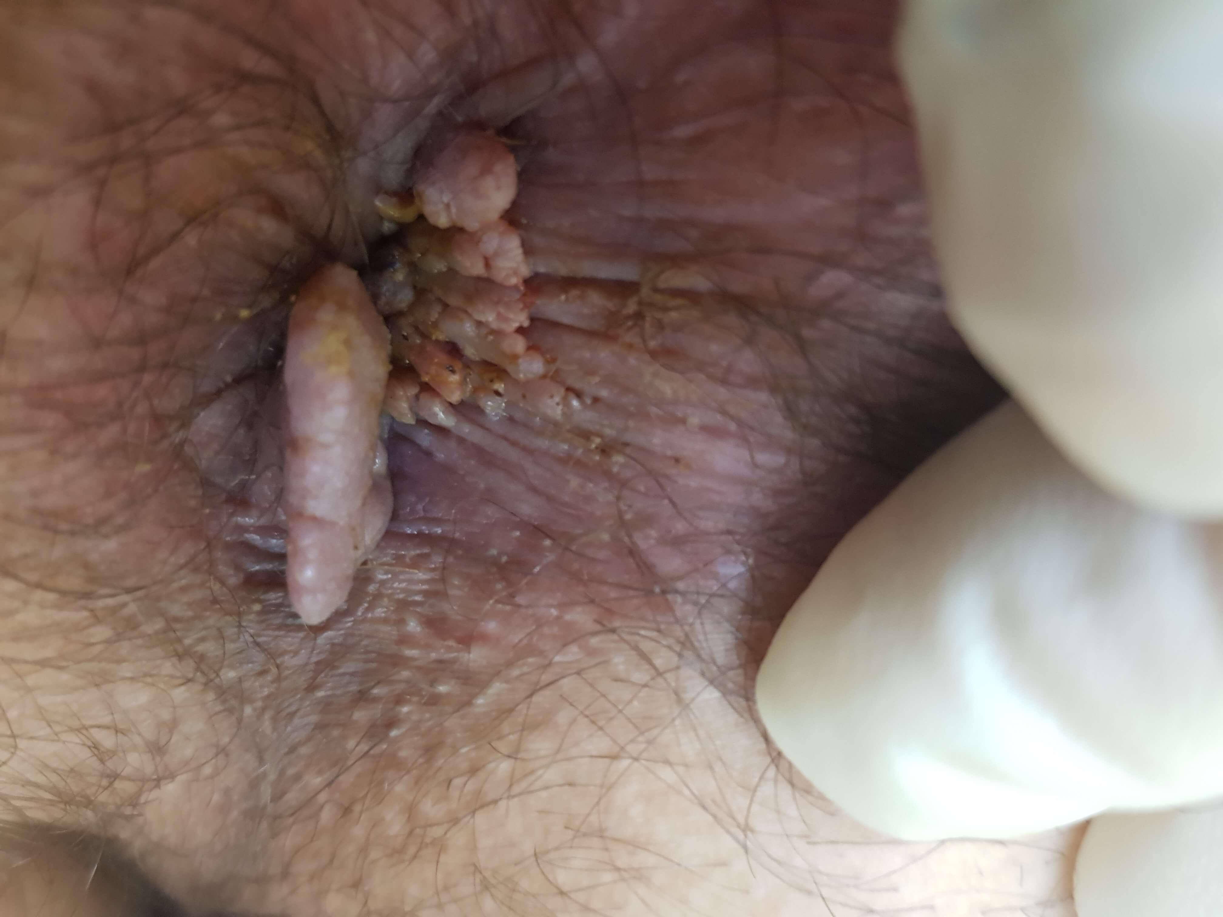 анализ на сифилис: положительно