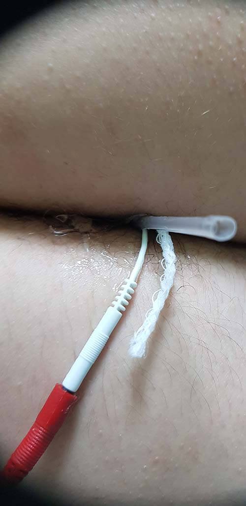 Электрофорез