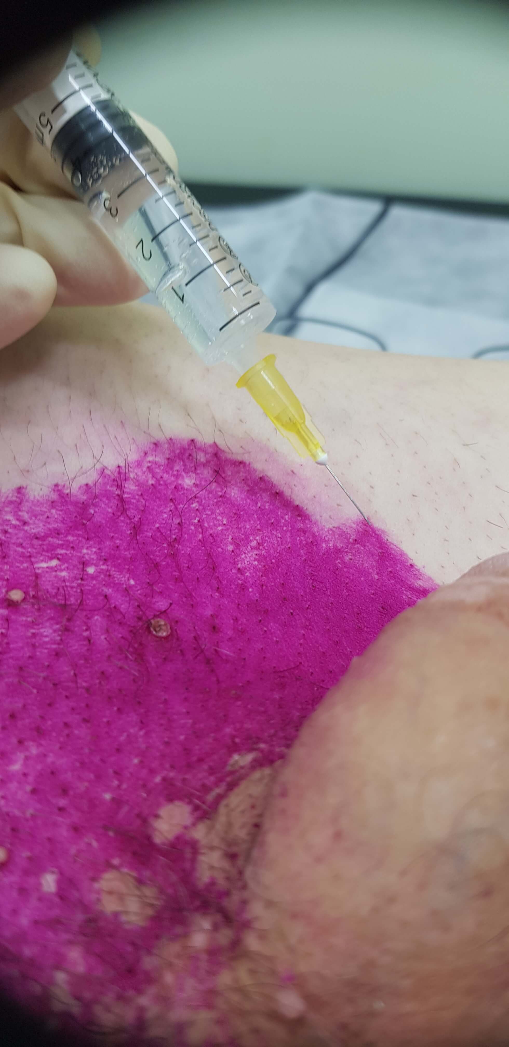 лимфотропное введение препаратов лимфотропка