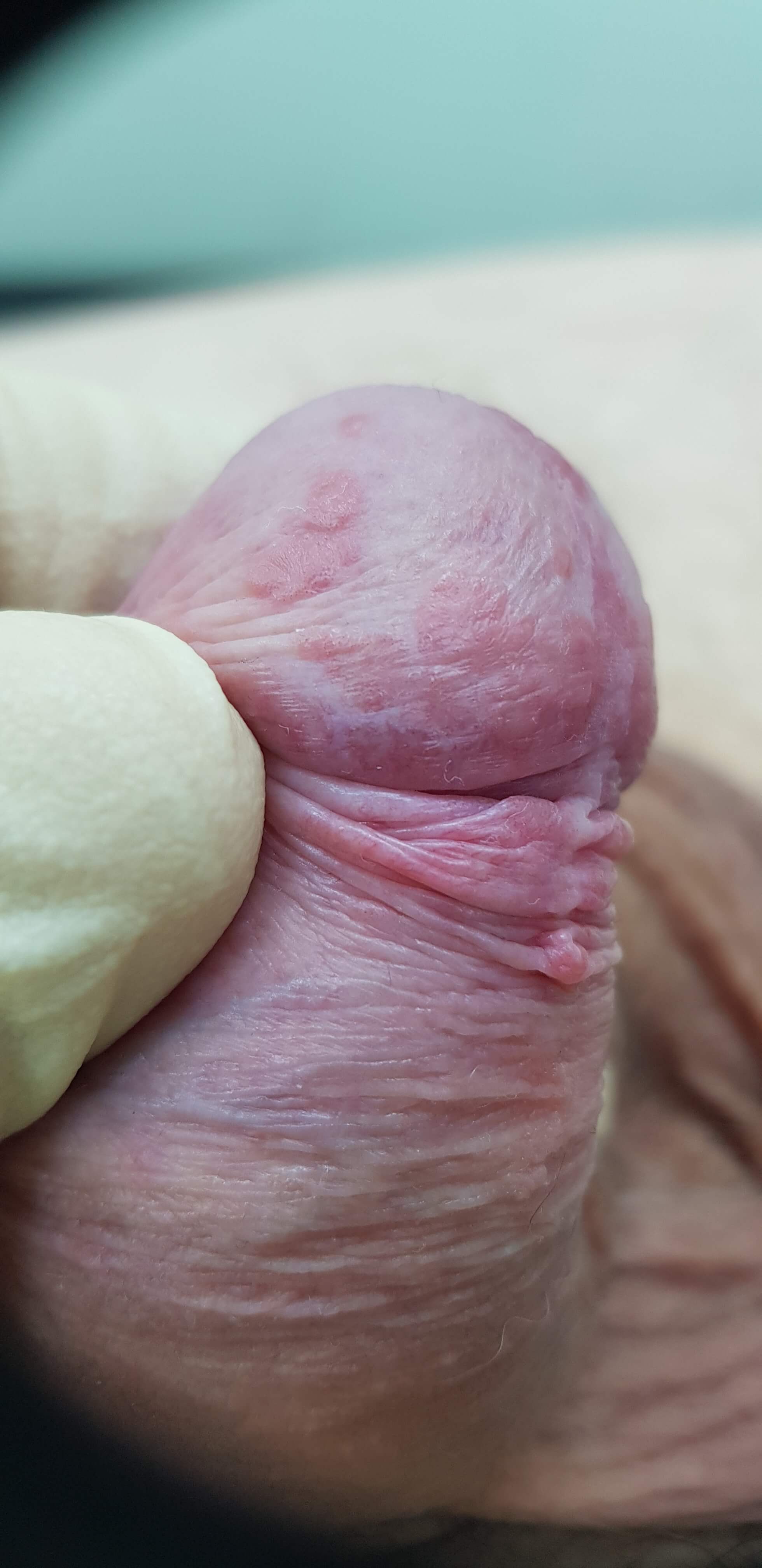 кондиломы на половом члене