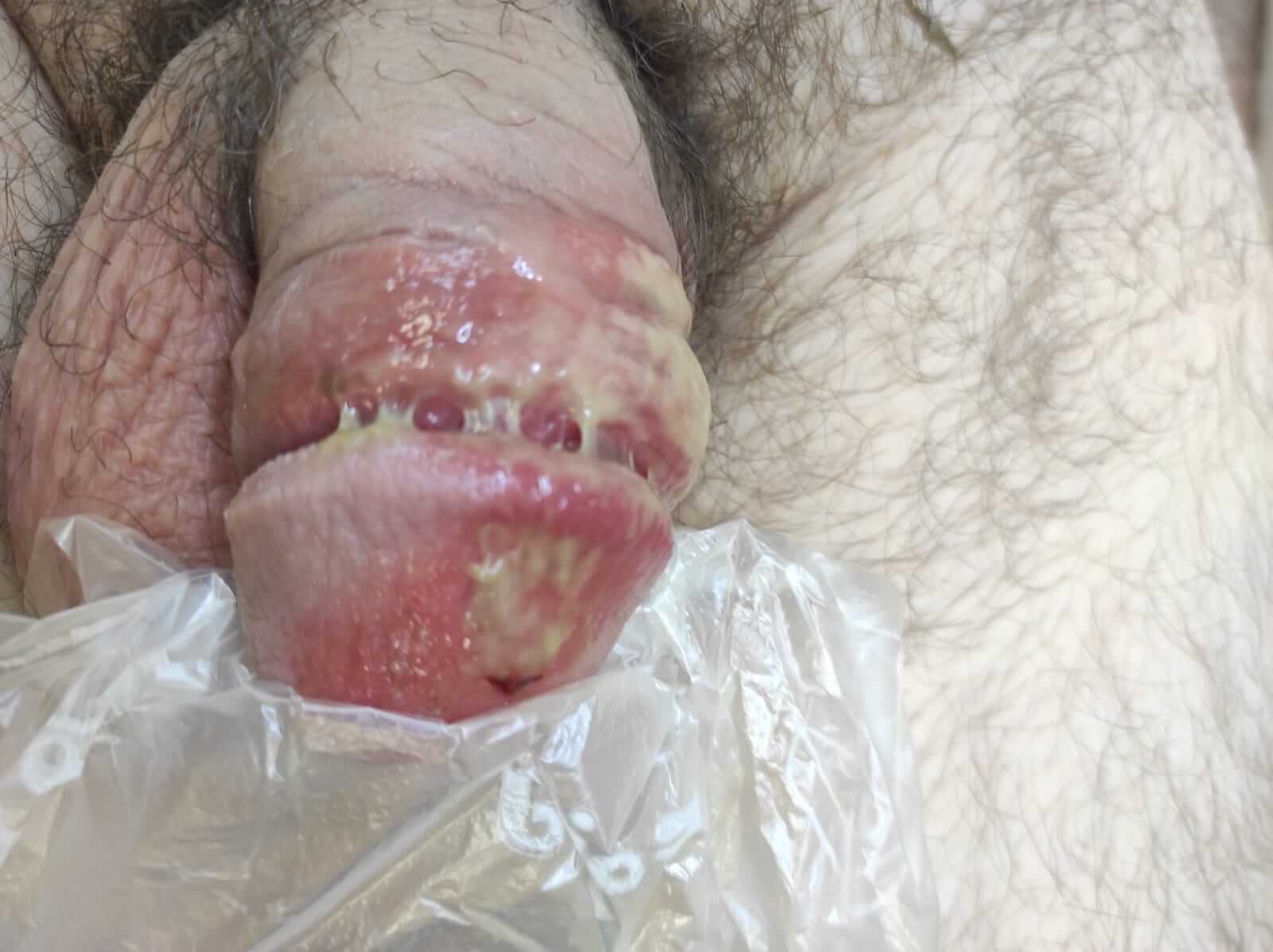 эрозия головки члена