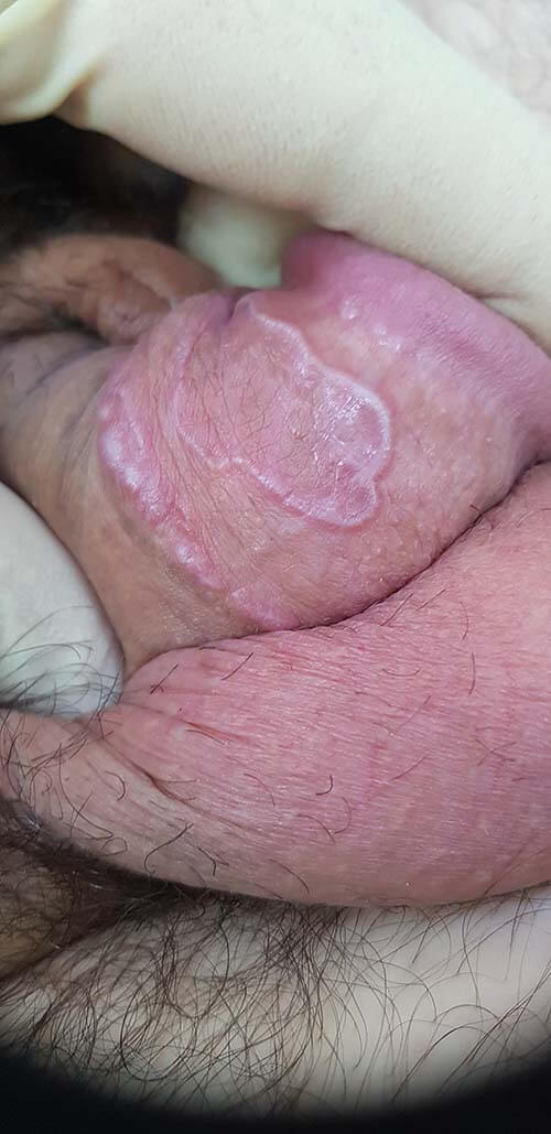 лишай Вильсона красный плоский лишай