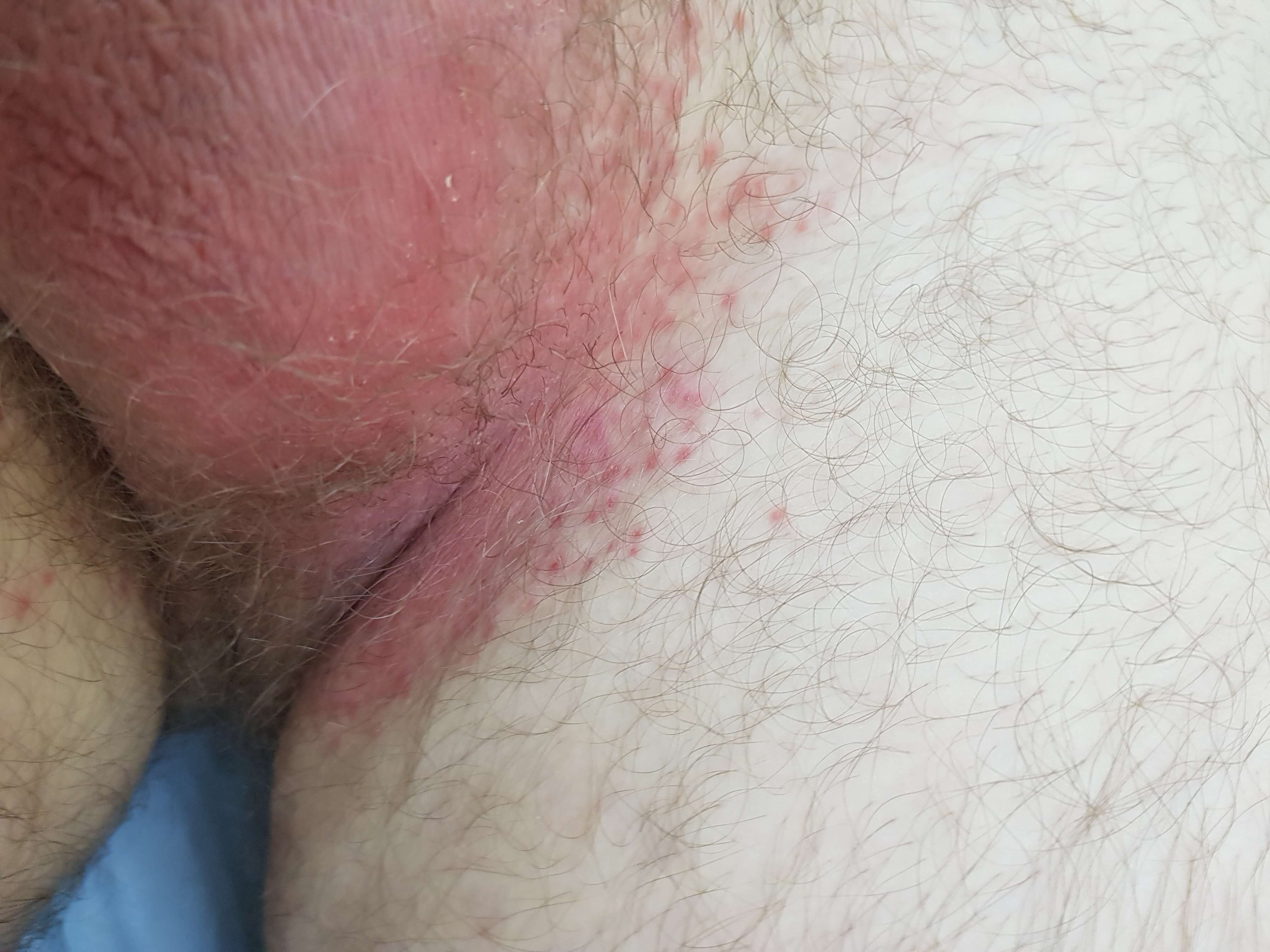 кандидозная опрелость