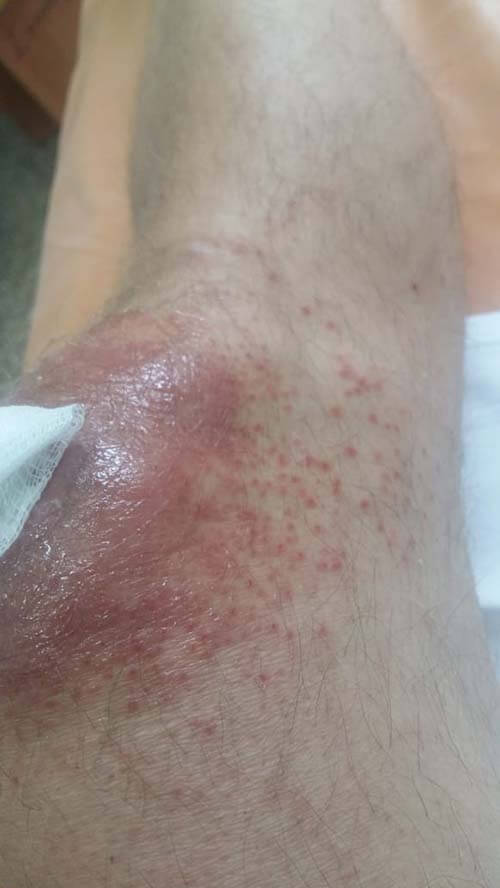 язва на колене