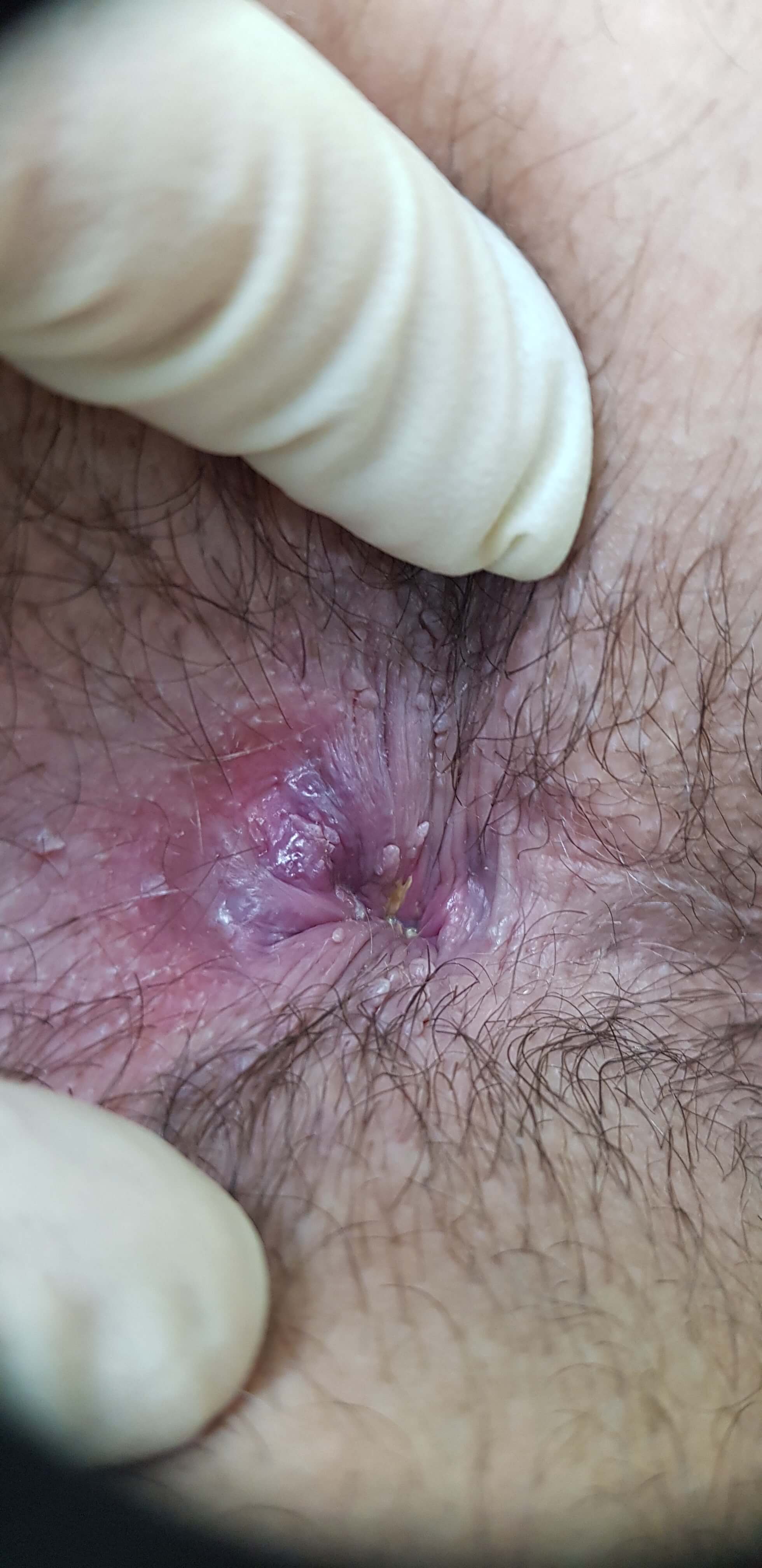 заражение при снижении иммунитета кондиломы ануса