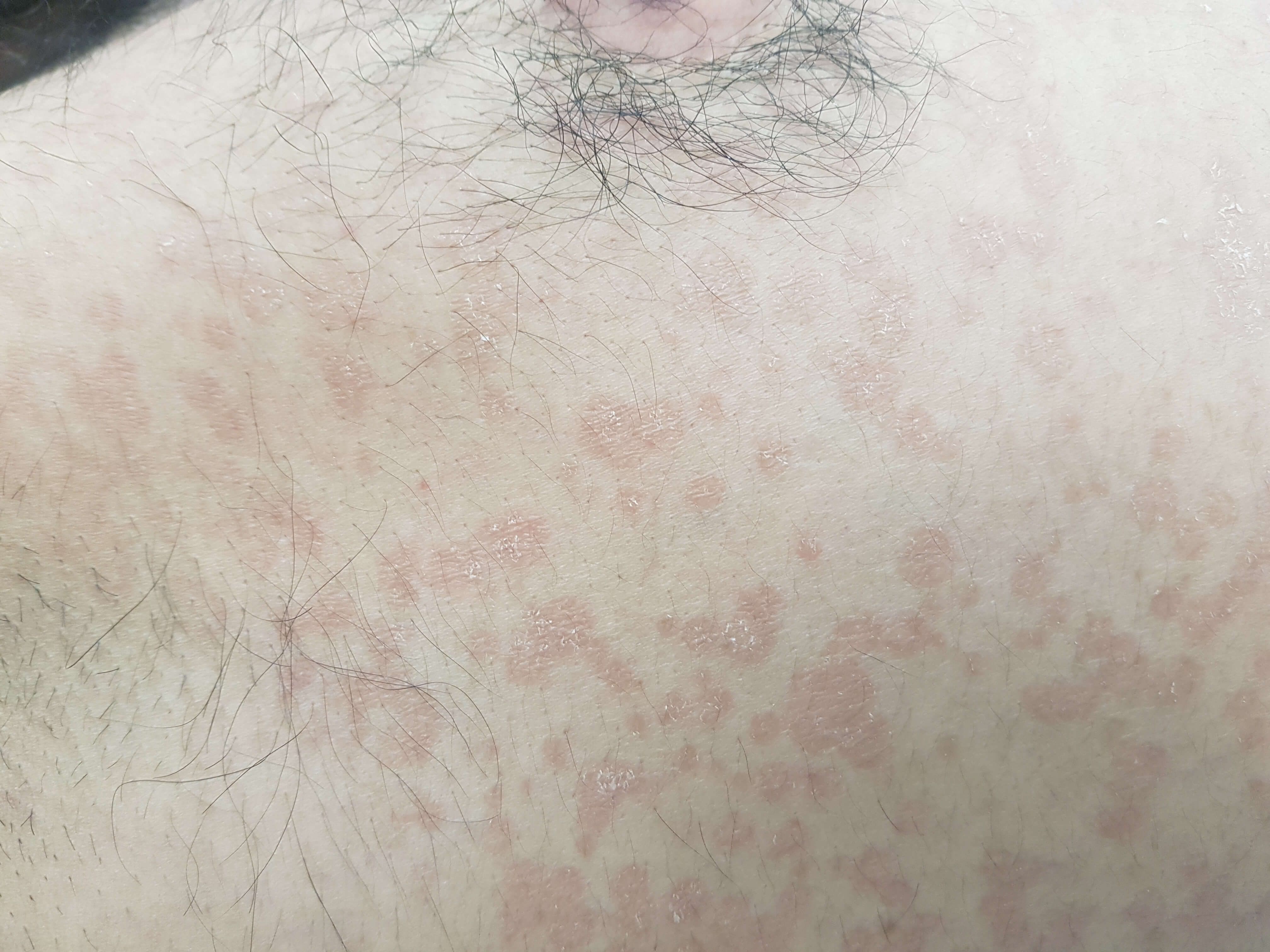 Разноцветный лишай