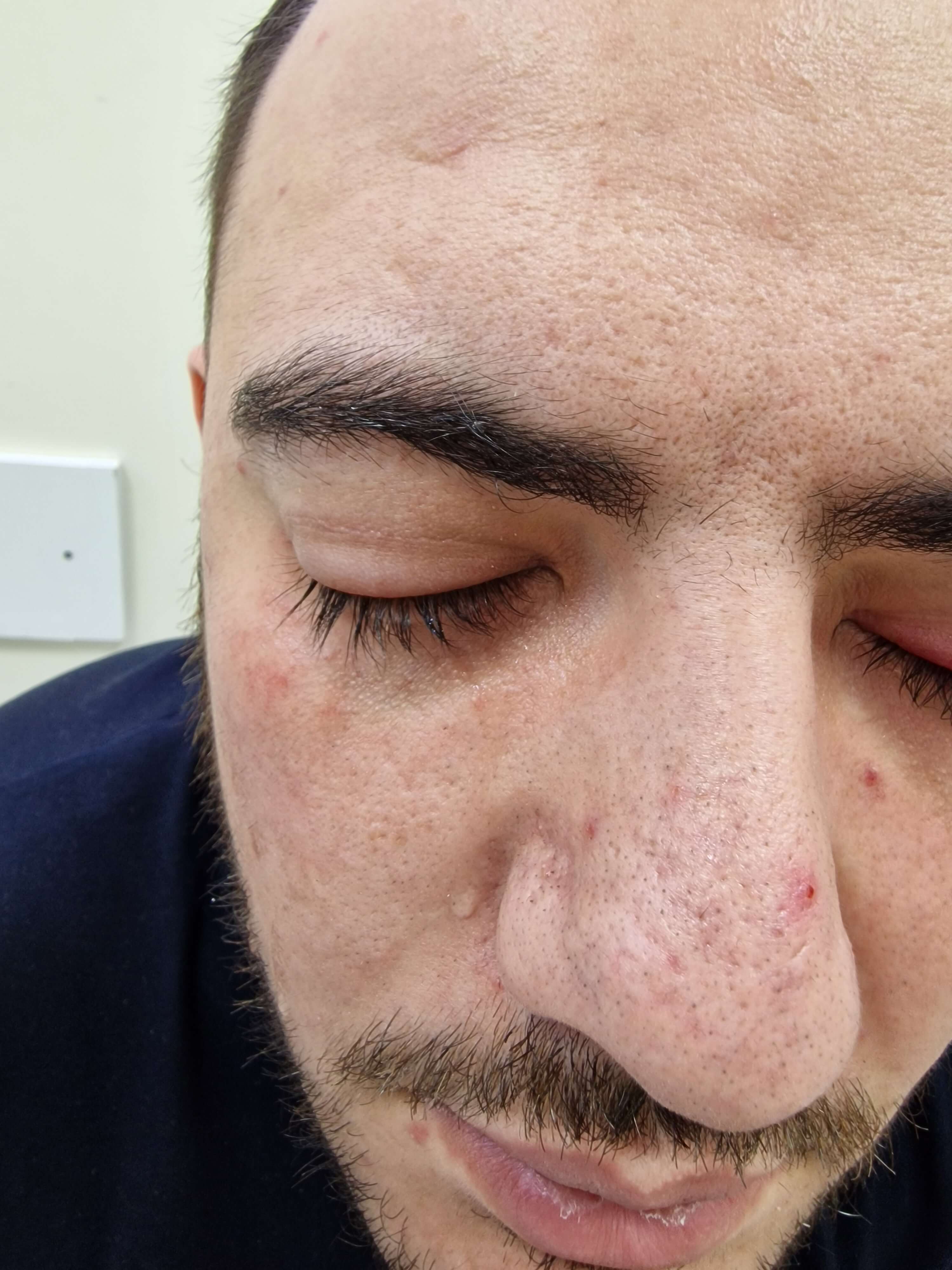 Воспаление слизистой оболочки глаза